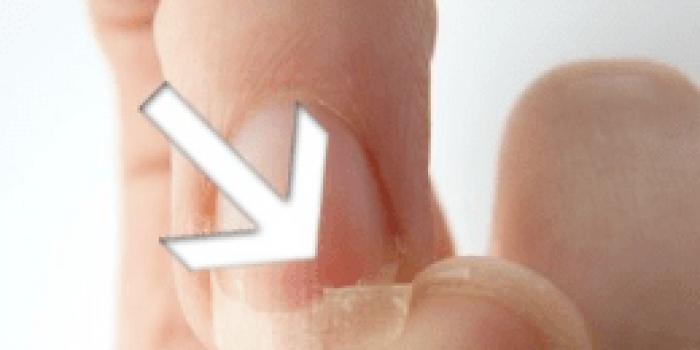 Причины расслоения ногтей и способы их лечения