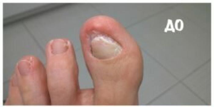 Белые пятна на ногтях рук: знаки судьбы или признак болезни?